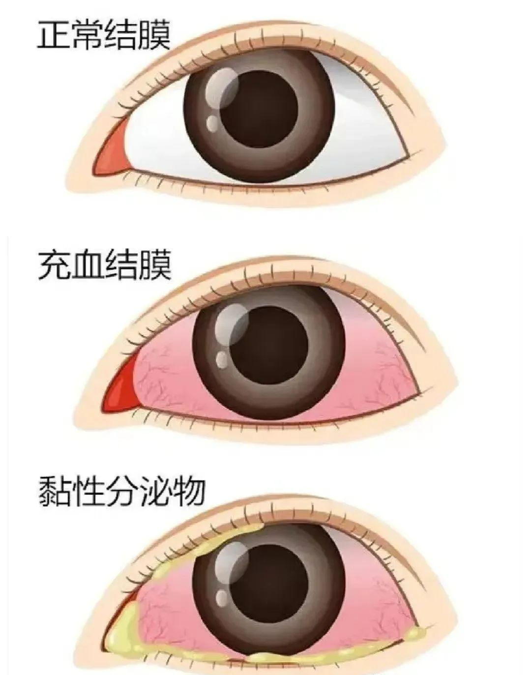 預(yù)防“紅眼病”，呵護(hù)眼健康——?？谑猩礁哂變簣@急性結(jié)膜炎預(yù)防知識(shí)宣傳活動(dòng)-圖片11